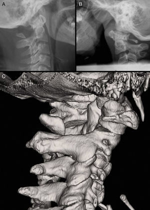 (A) Lateral radiograph of case 1. (B) Lateral radiograph of case 2, showing a remnant of the right arch. (C) 3D CT scan image of case 1.