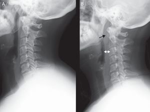(A) Lateral radiographic projection showing a normal prevertebral space (about 7mm at the C3 level and 3cm at the C7 level). (B) Anterior displacement of the airway due to a marked increase of the prevertebral space, mainly from C1 to C4. A radiodense image can be seen at the C1–C2 level. The time interval between both radiographs was 2 days.