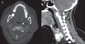 (A) Axial CT section showing calcification in a ventral location to the odontoid process and lateralised towards the left. (B) Sagittal CT reconstruction with contrast in soft tissue window which shows fluid collection in the prevertebral and retropharyngeal spaces. The absence of peripheral enhancement and adaptation to the space occupied are radiographic findings that help to differentiate it from an abscess.