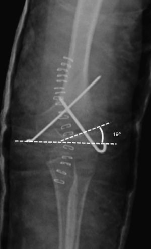 Baumann angle: used to evaluate reduction of the fracture. It is formed by the perpendicular to the longitudinal axis of the humerus with respect to the axis of the physeal line (normal range: 9–26°).