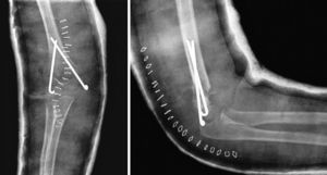Open reduction was performed in all cases by a posterior approach to the elbow and synthesis with Kirschner wires or Rush-type crossed intramedullary nails. After surgery, the operated limb was immobilised with a brachio-palmar splint or cast.