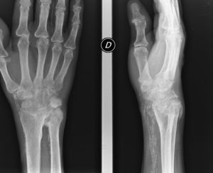 Anteroposterior and lateral radiographic images of the wrist.