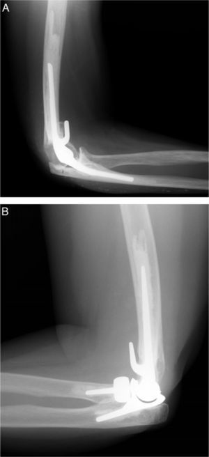 (A) Coonrad–Morrey linked elbow prosthesis. (B) Latitude® unlinked elbow prosthesis.