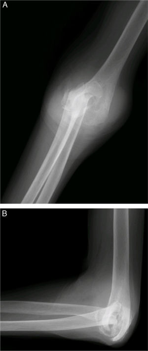 Preoperative radiograph of a patient with advanced rheumatoid arthritis and high degree of joint destruction. (A) Anteroposterior view. (B) Lateral view.