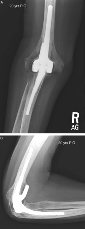 Anteroposterior (A) and lateral (B) radiographs, 20 years after implantation of a prosthetic elbow due to rheumatoid arthritis.