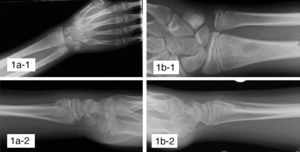 Plain radiographs. (A-1 and A-2) Anteroposterior and lateral radiographs of the wrist at the time of fracture. We can see a type II epiphysiolysis in the distal radius. (B-1 and B-2) Anteroposterior and lateral radiographs at 3 months of the fracture. We can see a geographical, osteolytic image in the metaphyso-diaphyseal area of the distal radius, at the level of the dorsal cortical.