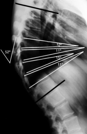 Simple lateral radiograph of an adolescent patient with Scheuermann's disease, showing a thoracic kyphosis of 52°. The measurement of the segmental wedging degree is obtained from the angle of intersection of the tangents on the superior and inferior plates of each vertebral body. The diagnostic criterion establishes a wedging greater than 5° in at least 3 consecutive vertebrae at the apex of the kyphosis.