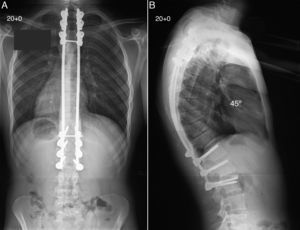 The patient underwent posterior spine arthrodesis using pedicular hooks and transpedicular screws, as well as multiple segmental closing osteotomies, resulting in excellent correction of the thoracic kyphosis up to 45°, with an adequate balance in the coronal and sagittal spinal planes (A and B).