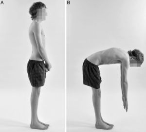 Postoperative clinical photographs in lateral standing (A) and lateral lumbar flexion (B) of the same male patient, 2 years after surgery, showing correction of the deformity. The surgical treatment of Scheuermann's disease obtains a very high level of patient satisfaction.