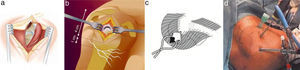 Systems of subacromial space approach. (a) Open: incision with a length of about 5cm and limited deltoid disinsertion. (b) Mini-open with an incision about 3–4cm in length. (c) Separating the deltoid fibres without disinserting them. (d) Arthroscopic.