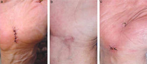 Different approaches to release the carpal tunnel. (a) Conventional shortened incision. (b) Endoscopic approach through 1 portal. (c) Endoscopic approach through 2 portals.