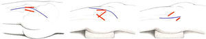 Minimally invasive variations (in thick lines) of classic routes (thin lines) for hip arthroplasty.