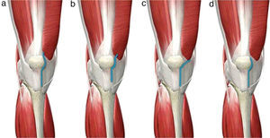 Minimally invasive knee approaches. (a) Medial parapatellar, reducing the length of the classical route and with minimal incision of the quadriceps tendon in the tendon insertion of the vastus medialis. (b) Midvastus, penetrating about 2cm through the vastus medialis muscle body. (c) Subvastus, raising the vastus medialis. (d) Quad-sparing, without altering the tendinous structures of the quadriceps.