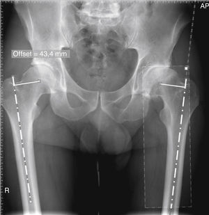 Once the X-ray magnification is calibrated, the data for the healthy hip are extrapolated for the hip to be operated on. Measurement of the horizontal femoral offset (distance from centre of rotation to the anatomical femoral axis) of the healthy hip (right hip in the figure). Extrapolation for the fractured hip (left hip in the figure). This step requires a final manual adjustment by the technician so that the references are placed exactly on the tip of the greater trochanter and on the centre of the femoral medullary canal of the fractured hip.