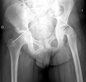 AP pelvis radiograph. Lateral Klein's line at the epiphysis in the left hip.