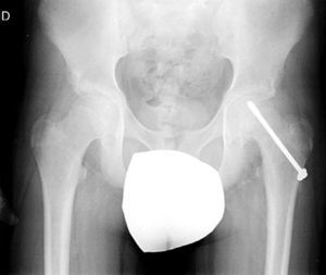 AP pelvis radiograph of a 13-year-old male patient. Stable epiphysiolysis treated with a partially threaded screw.