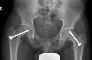 AP pelvis radiograph of a 14-year-old male patient with bilateral epiphysiolysis treated with partially threaded screws.