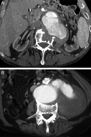 Angio-CT images showing the development of vertebral lysis associated with contained rupture of abdominal aortic aneurysms. The images correspond to cases 1 (A) and 5 (B).