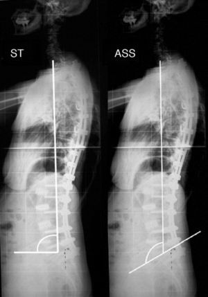 Spinal tilt (a) and spinal-sacral angle (b). A line is traced from the centre of the C7 vertebra to the centre of the sacral plate. The angle formed by this line with the sacral plate is the SSA, whilst the angle formed with the horizontal is the ST. They represent the position of C7 with respect to what should be the support base of the spine (pelvis).