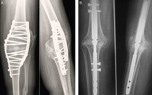 Anatomic tibiofemoral arthrodesis: double plate system (A) and Wichita® type intramedullary nail (B).
