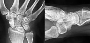 Anteroposterior and lateral radiograph of the right wrist. Note the fragmentation of the proximal pole of the scaphoid.