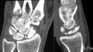 Coronal and sagittal CT sections confirming the fragmentation of the proximal pole of the scaphoid, with no signs of bone consolidation.