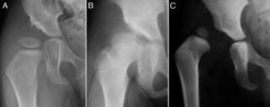 Anteroposterior pelvic radiograph showing acetabular dysplasia (A), hip subluxation (B) and hip dislocation (C).