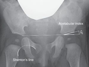 Anteroposterior pelvic radiograph. Shenton's line (right hip) is the measurement used to assess the relationship of the acetabulum and the proximal femur. The acetabular index (left hip) is the measurement used to assess the morphology of the acetabulum.