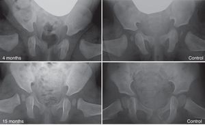 Residual dysplasia following treatment with a Pavlik harness. The image in the upper left quadrant shows an anteroposterior pelvic radiograph of a 4-month-old patient at the start of treatment with the harness. The image in the lower left quadrant is an anteroposterior pelvic radiograph of the same patient at 15 months of age, showing residual acetabular dysplasia despite treatment with the Pavlik harness. The images on the right correspond to anteroposterior radiographs of a normal pelvis: at 4 months of age in the case of the upper right quadrant and at 15 months of age in the case of the lower right quadrant.