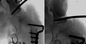 Images corresponding to a case of residual hip dysplasia treated with varisating and derotatory osteotomy and a Dega type acetabuloplasty.