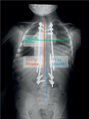 Anterior–posterior teleradiography of a patient with early-onset scoliosis in treatment with dual growing rods. You can see the T1-T12 distance (the vertical line that joins the upper endplate of T1 with the lower endplate of T12), the T1-S1 distance (the vertical line that joins the upper endplate of T1 with the upper border of S1), and the coronal anchor of the thorax at the level of T6.