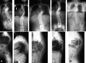Case 1. Patient with idiopathic scoliosis. At 2 years of age, posterior fusion was performed in situ (A). The postoperative images show moderate correction (B). At 10 years old, the patient developed a crankshaft phenomenon with an increase in the frontal Cobb angle of 14° and the development of a very marked rotational kyphosis of 110° (C). An anterior approach was performed to halt the sagittal rotation collapse, with discectomy, arthrodesis and pedicle rib graft (D). Thirteen years later, at the age of 25 (E), the patient remains balanced and the graft has provided protection against an increase in the collapse.