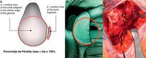Glenoid bone defect. (A) Measurement of defect. (B) 3D CT reconstruction of glenoid bone defect. (C) Latarjet technique.
