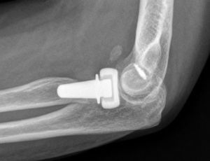 Heterotopic ossifications in the anterior side of the radial neck, with limited range of motion, which involved no functional impact.