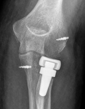 Radiograph showing painless capitellar changes with an apparently adequate prosthetic size.