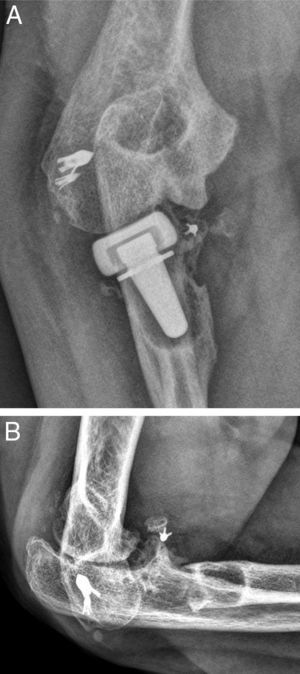 (A) Presence of periprosthetic osteolysis with heterotopic calcifications and severe ulnohumeral arthrosis, causing painful symptoms in the radial region of the elbow. (B) Lateral radiograph showing the resection arthroplasty of the radial implant.