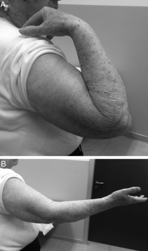 Functional results after resection arthroplasty. (A) Range of flexion: 135° and (B) flexion contracture: 20°.