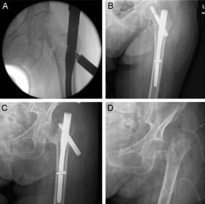 Fracture with a basicervical line treated by PFNA nailing. During its introduction, the helical blade reached the subchondral bone so it was partially removed, revealing the channel created by compaction of the trabeculae (A). Postoperative control (B). Cut out (C). Definitive treatment through a Girdlestone procedure (D).
