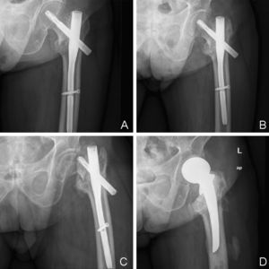 Pertrochanteric fracture with a simple line treated by PFNA nailing. Postoperative control (A). A slight collapse took place during the evolution, which was consolidated with lateral migration of the blade (B). The point of fracture can be observed at a subcapital level (coinciding with the tip of the blade), along with nonunion. Cut out. (C). We opted for surgical treatment by hemiarthroplasty with a Thompson type cemented prosthesis (D).