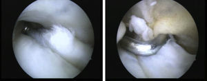 Partial longitudinal tear of the PB, tendoscopic debridement.