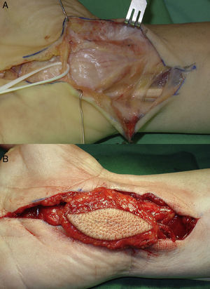 (A) Intraoperative image showing the LFH of the median nerve, after release of the carpal tunnel. (B) The interosseous fascio-fatty-cutaneous flap was transposed to the anterior side of the mass of the LFH to improve vascularization of the median nerve and the quality of palmar skin.