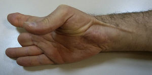 Image showing the path of the palmaris longus tendon, which enables adequate anteposition and pinching. The transposed graft enables excellent coverage of the volar side of the wrist.