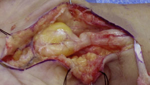 Case 2: lipofibrohamartoma of the median nerve. A significant stenosis can be observed proximal to the pseudotumor, corresponding to the mark of the annular ligament of the carpus on the nerve. The difference in coloring and loss of surrounding adipose tissue due to extrinsic compression can also be observed. To the right of the image is the palmaris longus tendon, used to monitor the thumb.