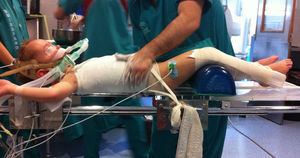 Placement technique of a derotatory cast. The chin is held by the chin strap, the entire thorax and abdomen remain free, and the lower limbs under traction. The maneuver consists in derotating the ribs manually.