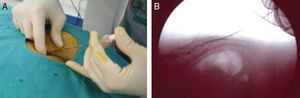 (A) The sacral hiatus is located between the 2 sacral horns, in the midline, near the superior part of the gluteal cleft. The needle was advanced through the sacrococcygeal ligament and then advanced 1–2cm within the caudal canal. (B) Control was carried out through non-ionic contrast to ensure the correct placement of the spinal cannula.