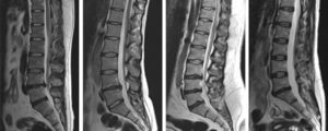 All patients presented variable signs of degenerative lumbar disk disease in the MRI according to the Pfirrmann classification, with involvement of between 1 and 4 levels. Some patients also presented Modic-type changes in the adjacent vertebral endplates.