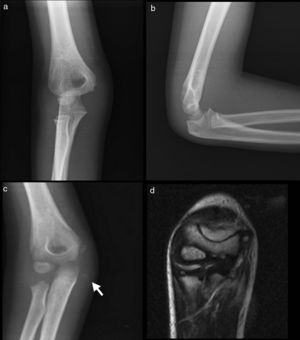 (A) Initial anteroposterior radiograph of the elbow showing no evidence of lesion. (B) Initial lateral radiograph of the lesion. (C) Anteroposterior radiographic projection identifying a radiopaque image in the medial aspect of the condyle. (D) An MRI study confirms the occupation of the retroepitrochlear canal.