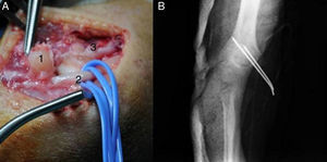 (A) Intraoperatively, we observed compression of the ulnar nerve (number 2) by the incarcerated epitrochlear fragment (number 1), which was subsequently fixed to the humeral bed (number 3). (B) Postoperative radiographic control.