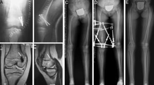 Case 5: a 7-year-old girl who suffered type III epiphysiolysis of the distal femur after a traffic accident. We performed an incorrect osteosynthesis using transfixing screws on the physis (A). We subsequently removed the screws and obtained an MRI study (9 months after the initial lesion), which revealed the presence of a posteromedial physeal bridge (B). In spite of the surgical resection of the bridge, the injured physis did not regain growth (C) and led to the development of a 5.6cm shortening compared to the contralateral limb, as well as a varus deformity of 4.5° (anatomical lateral distal femoral angle: 106°) and antecurvatum deformity (anatomical posterior distal femoral angle: 57°). We opted for lengthening-correction osteotomy using a circular external fixator (D). At 6 years after the initial lesion, the control teleradiograph obtained (E) showed a neutral alignment of the limb with a length discrepancy of just 2mm (B).