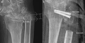 Preoperative AP radiograph of the wrist with measurements of ulnar variance (a) and postoperative with measurements of level and length of the osteotomy (b).